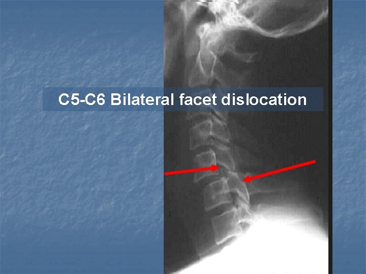 C 5 -C 6 Bilateral facet dislocation 