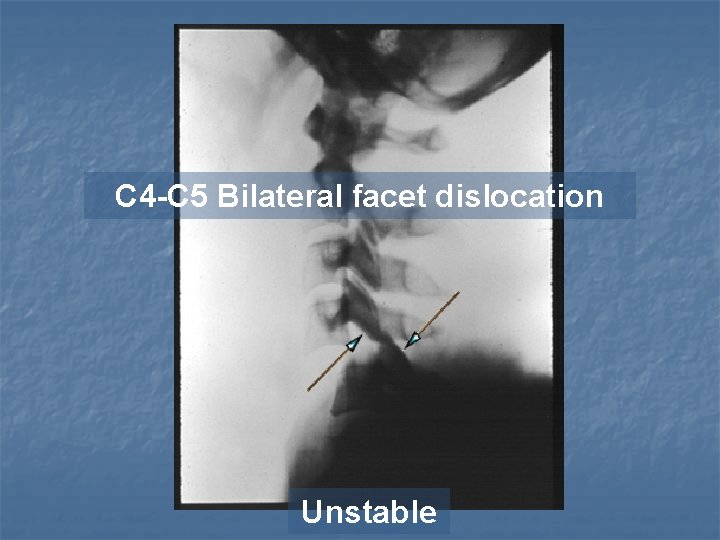 C 4 -C 5 Bilateral facet dislocation Unstable 