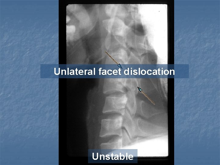 Unlateral facet dislocation Unstable 