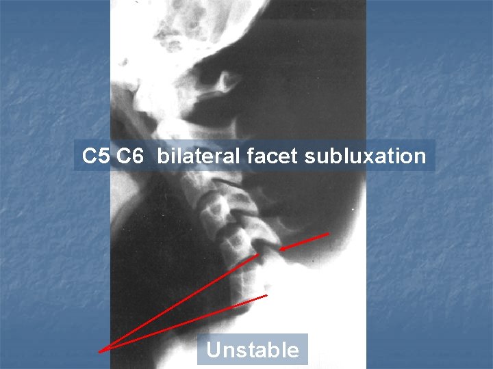 C 5 C 6 bilateral facet subluxation Unstable 