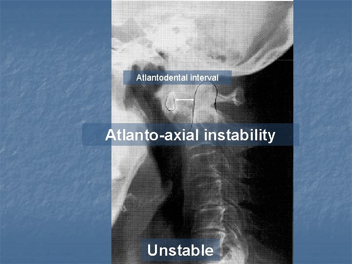 Atlantodental interval Atlanto-axial instability Unstable 
