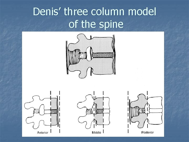 Denis’ three column model of the spine 