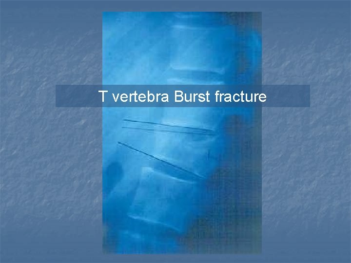 T vertebra Burst fracture 