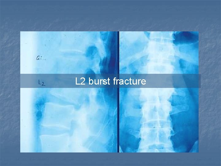 L 2 burst fracture 
