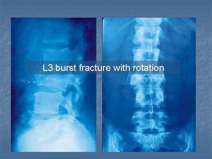 L 3 burst fracture with rotation 