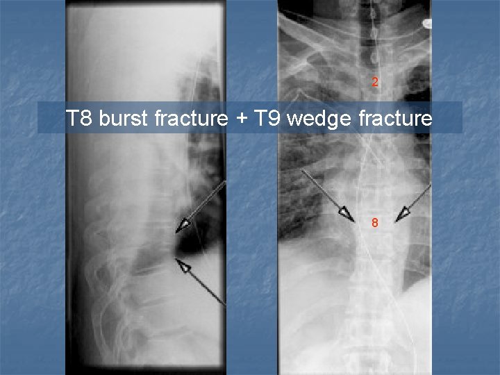 2 T 8 burst fracture + T 9 wedge fracture 8 