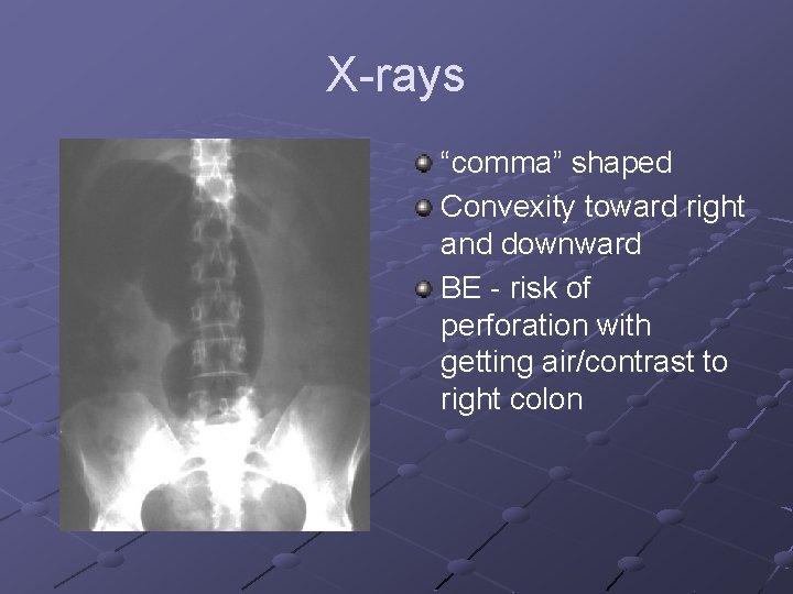 X-rays “comma” shaped Convexity toward right and downward BE - risk of perforation with X-rays “comma” shaped Convexity toward right and downward BE - risk of perforation with