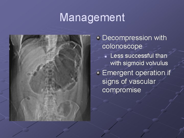 Management Decompression with colonoscope n Less successful than with sigmoid volvulus Emergent operation if Management Decompression with colonoscope n Less successful than with sigmoid volvulus Emergent operation if