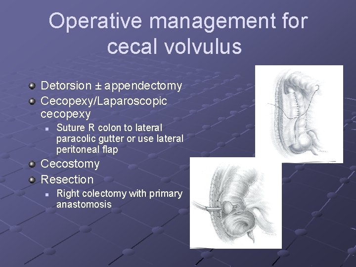 Operative management for cecal volvulus Detorsion ± appendectomy Cecopexy/Laparoscopic cecopexy n Suture R colon Operative management for cecal volvulus Detorsion ± appendectomy Cecopexy/Laparoscopic cecopexy n Suture R colon