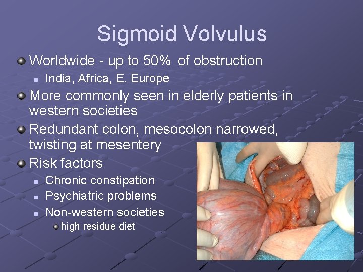 Sigmoid Volvulus Worldwide - up to 50% of obstruction n India, Africa, E. Europe Sigmoid Volvulus Worldwide - up to 50% of obstruction n India, Africa, E. Europe