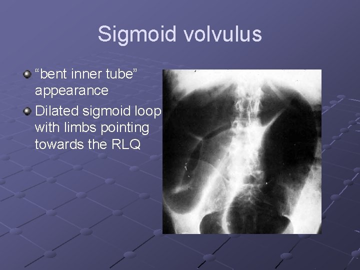 Sigmoid volvulus “bent inner tube” appearance Dilated sigmoid loop with limbs pointing towards the Sigmoid volvulus “bent inner tube” appearance Dilated sigmoid loop with limbs pointing towards the