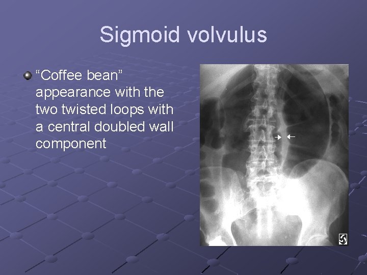 Sigmoid volvulus “Coffee bean” appearance with the two twisted loops with a central doubled Sigmoid volvulus “Coffee bean” appearance with the two twisted loops with a central doubled