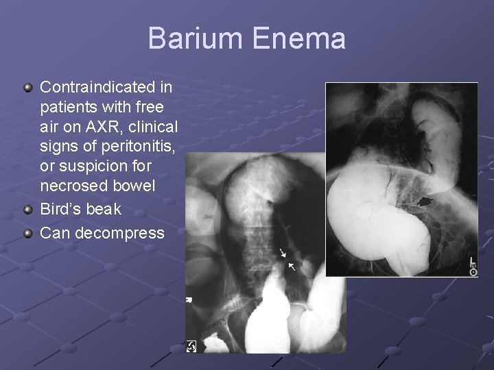 Barium Enema Contraindicated in patients with free air on AXR, clinical signs of peritonitis, Barium Enema Contraindicated in patients with free air on AXR, clinical signs of peritonitis,