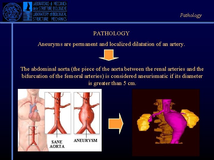 Pathology PATHOLOGY Aneuryms are permanent and localized dilatation of an artery. The abdominal aorta