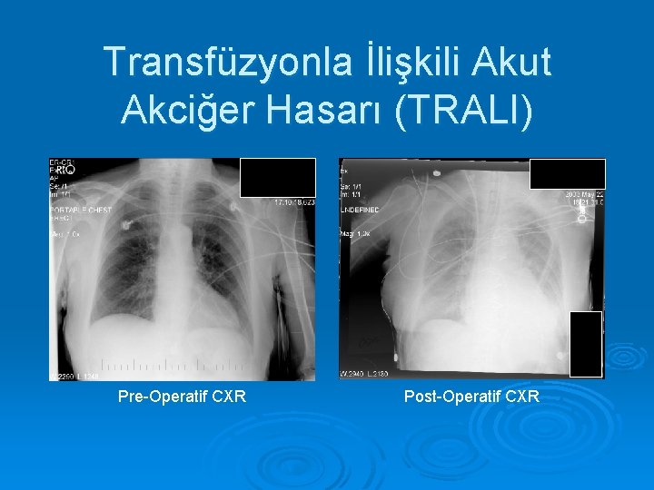 Transfüzyonla İlişkili Akut Akciğer Hasarı (TRALI) Pre-Operatif CXR Post-Operatif CXR 