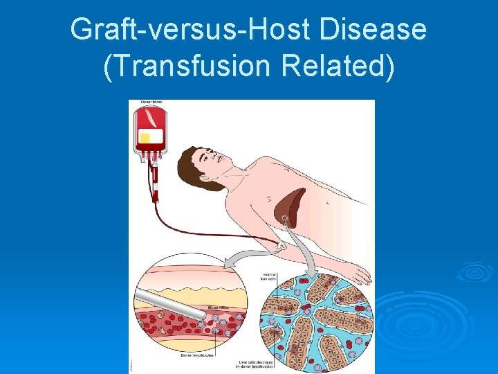 Graft-versus-Host Disease (Transfusion Related) 