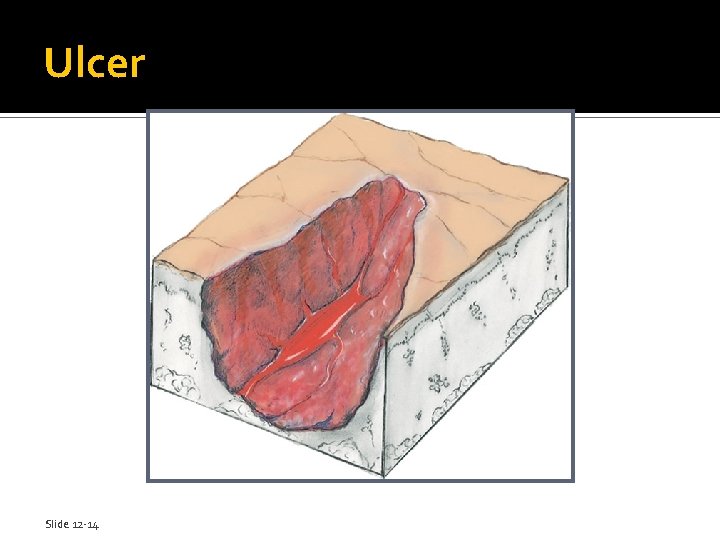 Ulcer Slide 12 -14 