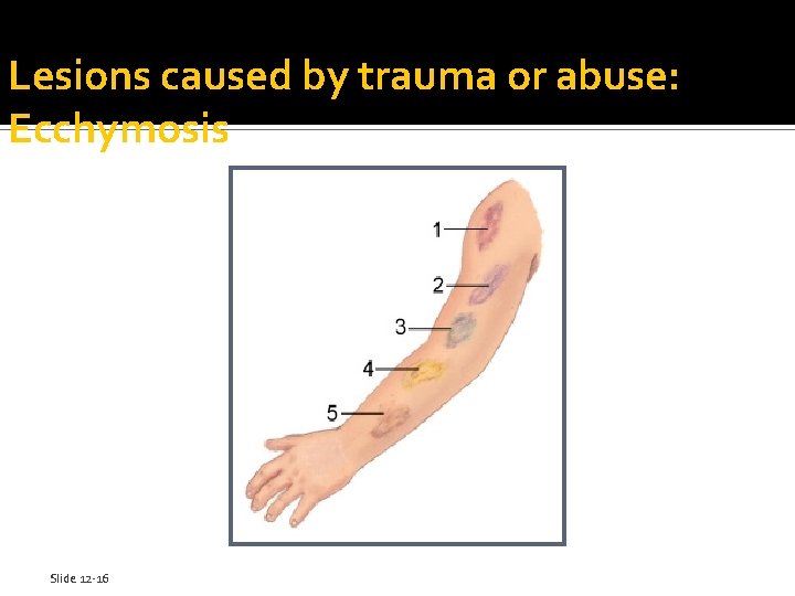 Lesions caused by trauma or abuse: Ecchymosis Slide 12 -16 