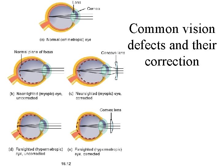 Fig. 16. 12 Common vision defects and their correction 