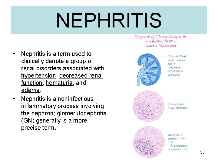 NEPHRITIS • Nephritis is a term used to clinically denote a group of renal