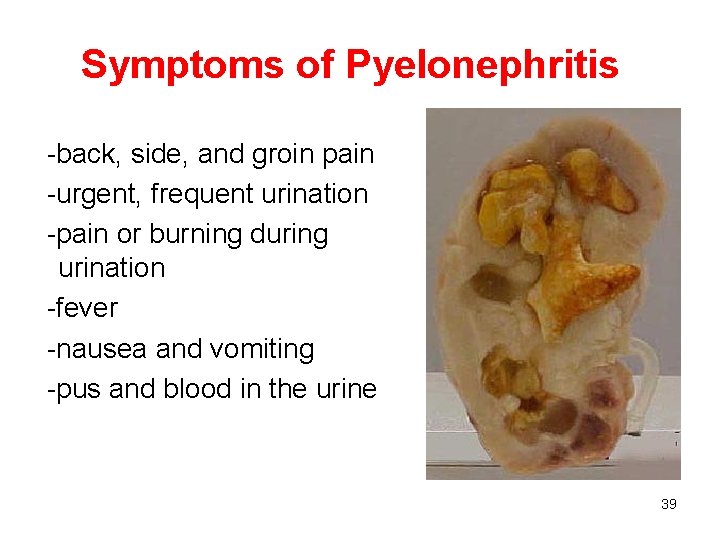 Symptoms of Pyelonephritis -back, side, and groin pain -urgent, frequent urination -pain or burning