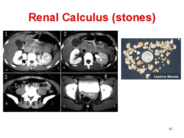 Renal Calculus (stones) 41 