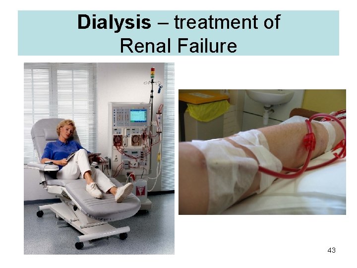 Dialysis – treatment of Renal Failure 43 