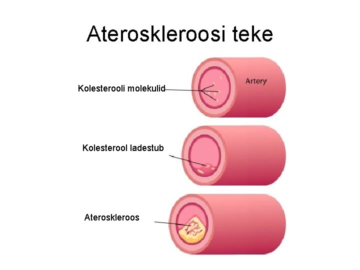 Ateroskleroosi teke Kolesterooli molekulid Kolesterool ladestub Ateroskleroos 