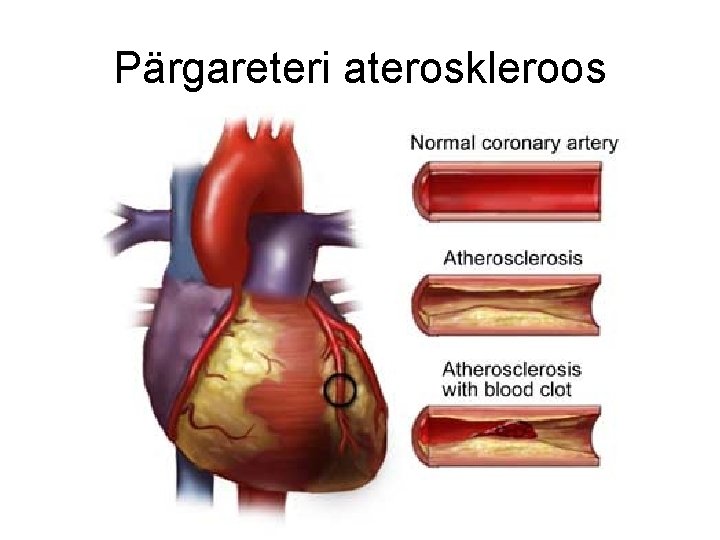 Pärgareteri ateroskleroos 