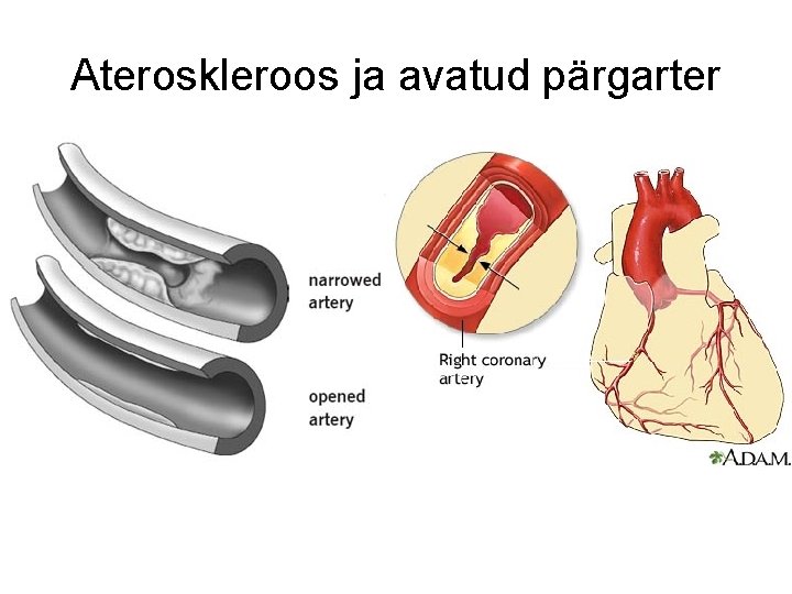 Ateroskleroos ja avatud pärgarter 