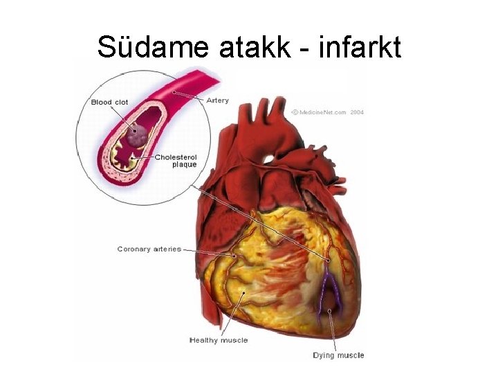 Südame atakk - infarkt 