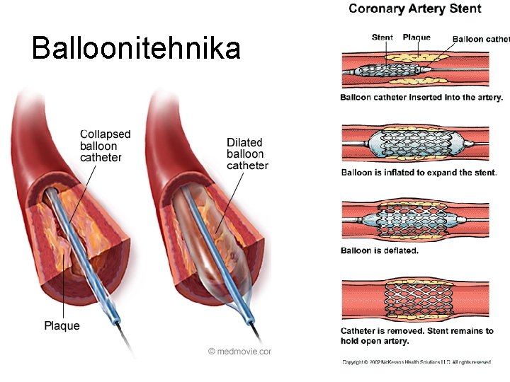 Balloonitehnika 