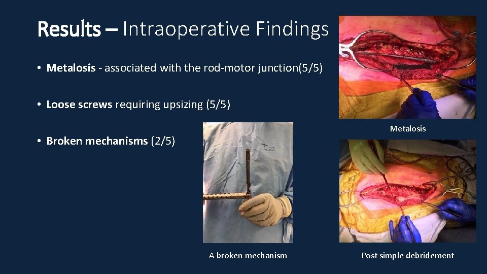 Results – Intraoperative Findings • Metalosis - associated with the rod-motor junction(5/5) • Loose
