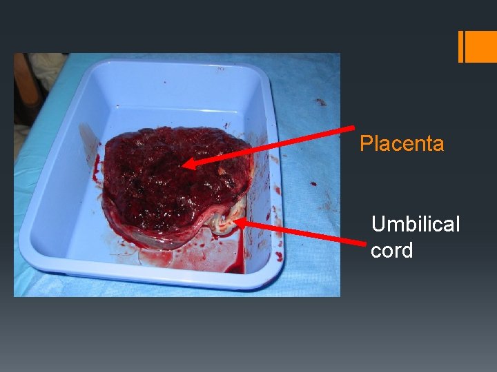 Placenta Umbilical cord 