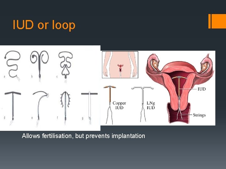 IUD or loop Allows fertilisation, but prevents implantation 