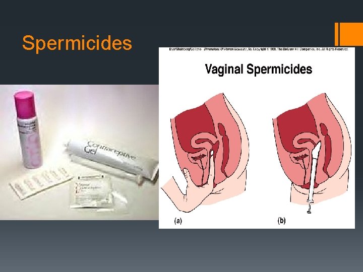 Spermicides Diaphragm 