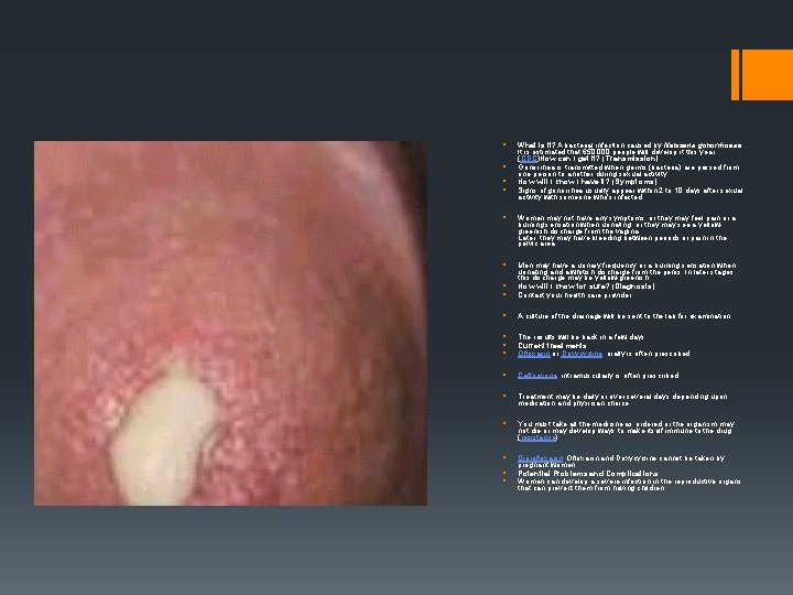 § § Gonorrrhoea § § What is it? A bacterial infection caused by Neisseria