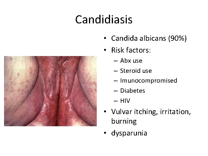 Candidiasis • Candida albicans (90%) • Risk factors: – – – Abx use Steroid Candidiasis • Candida albicans (90%) • Risk factors: – – – Abx use Steroid