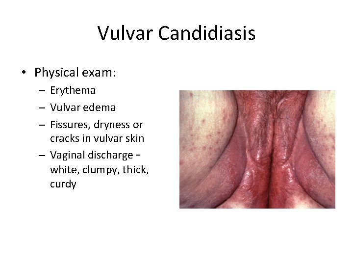 Vulvar Candidiasis • Physical exam: – Erythema – Vulvar edema – Fissures, dryness or Vulvar Candidiasis • Physical exam: – Erythema – Vulvar edema – Fissures, dryness or