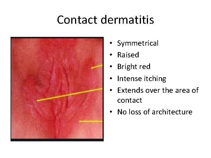 Contact dermatitis Symmetrical Raised Bright red Intense itching Extends over the area of contact Contact dermatitis Symmetrical Raised Bright red Intense itching Extends over the area of contact
