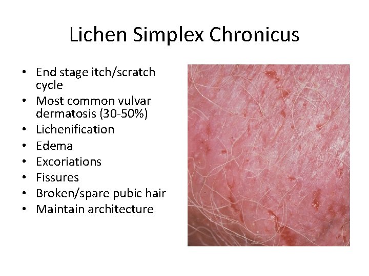 Lichen Simplex Chronicus • End stage itch/scratch cycle • Most common vulvar dermatosis (30 Lichen Simplex Chronicus • End stage itch/scratch cycle • Most common vulvar dermatosis (30