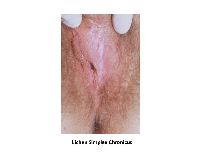 Lichen Simplex Chronicus Lichen Simplex Chronicus