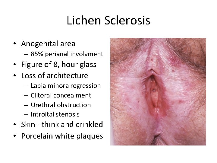 Lichen Sclerosis • Anogenital area – 85% perianal involvment • Figure of 8, hour Lichen Sclerosis • Anogenital area – 85% perianal involvment • Figure of 8, hour