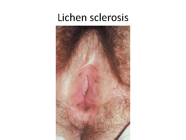 Lichen sclerosis Lichen sclerosis