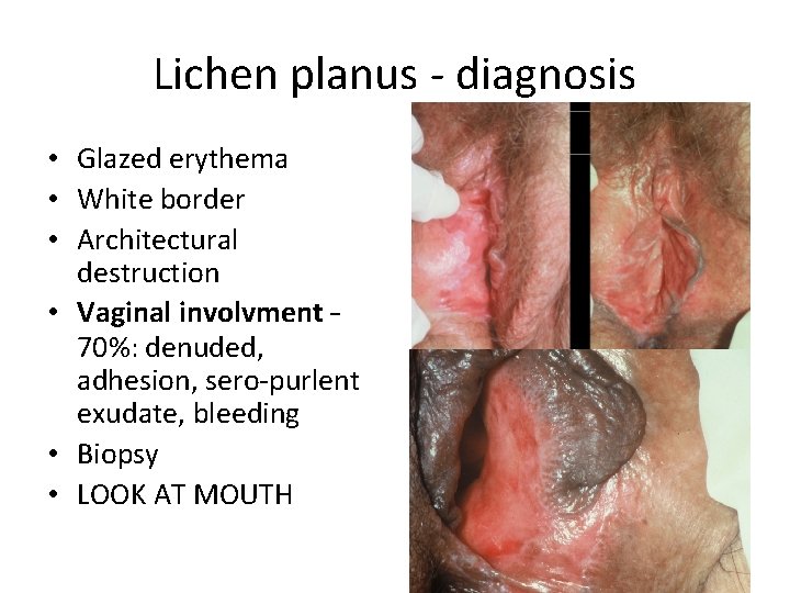 Lichen planus - diagnosis • Glazed erythema • White border • Architectural destruction • Lichen planus - diagnosis • Glazed erythema • White border • Architectural destruction •