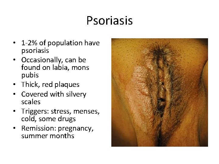 Psoriasis • 1 -2% of population have psoriasis • Occasionally, can be found on Psoriasis • 1 -2% of population have psoriasis • Occasionally, can be found on