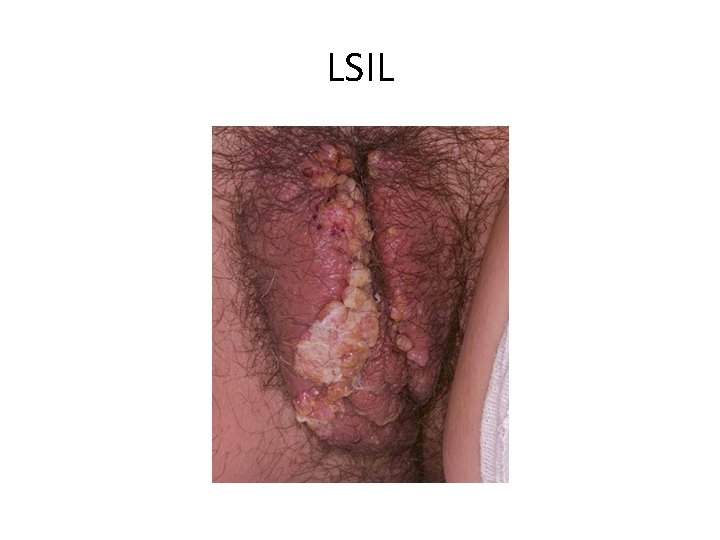 LSIL LSIL