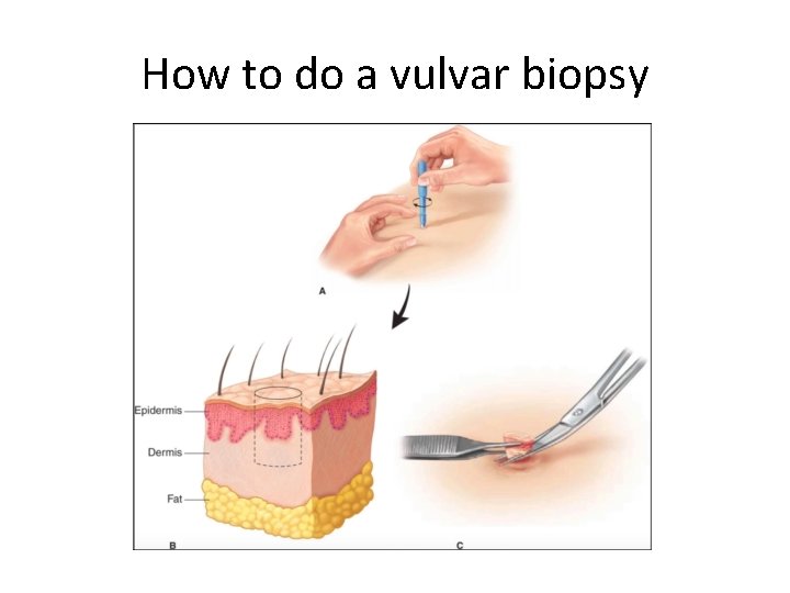 How to do a vulvar biopsy How to do a vulvar biopsy