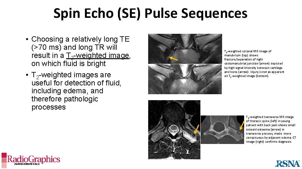 Spin Echo (SE) Pulse Sequences • Choosing a relatively long TE (>70 ms) and