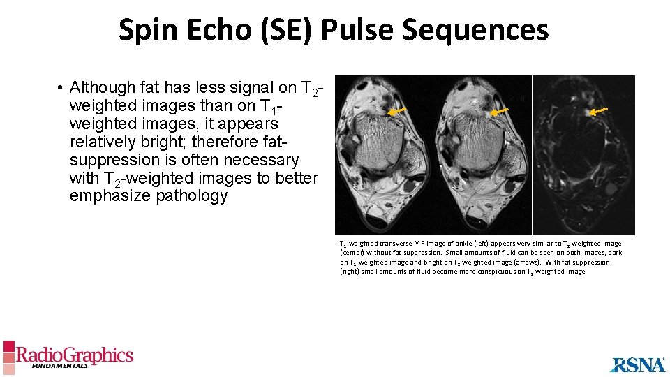 Spin Echo (SE) Pulse Sequences • Although fat has less signal on T 2